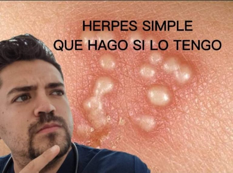 Herpes simple, la enfermedad que te acompaña toda la vida.